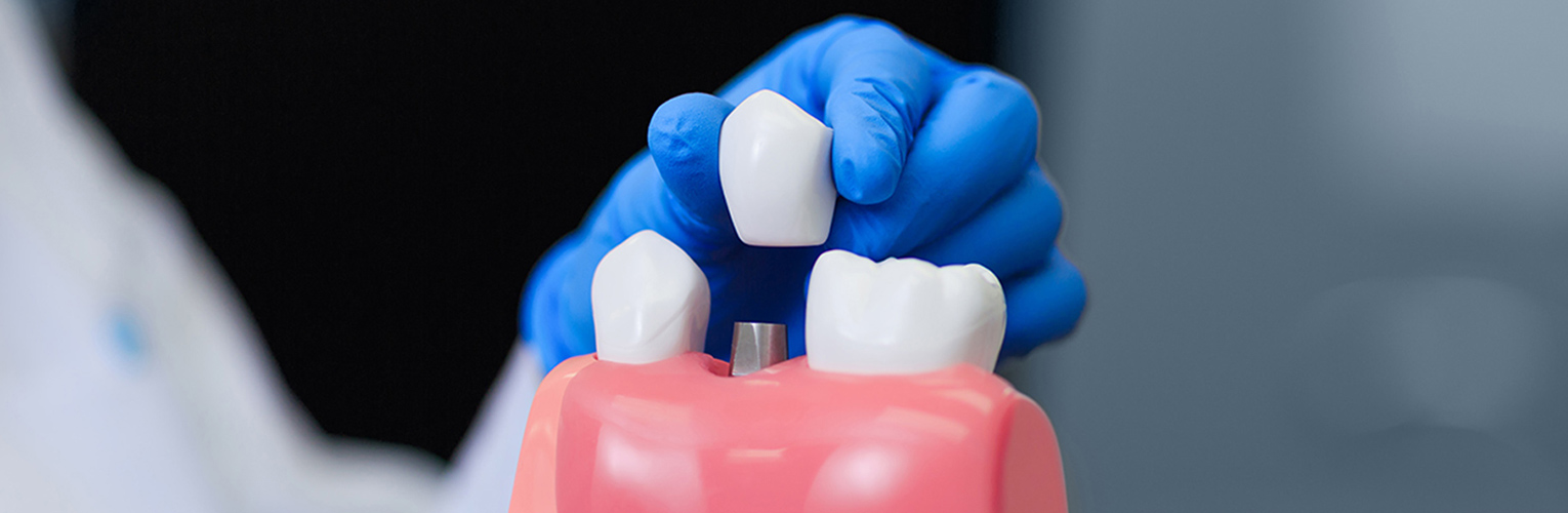 Would You Consider Dental Implants To Replace Missing Teeth?