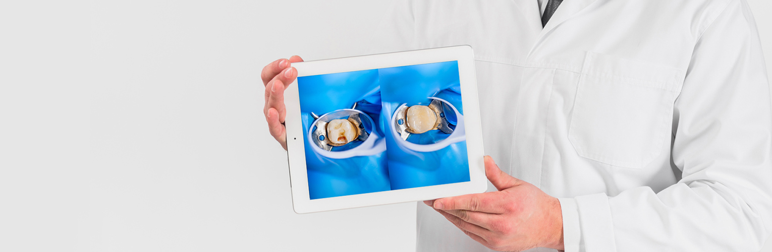 Consider Dental Crowns For Your Decayed or Damaged Teeth Before Incurring Additional Losses
