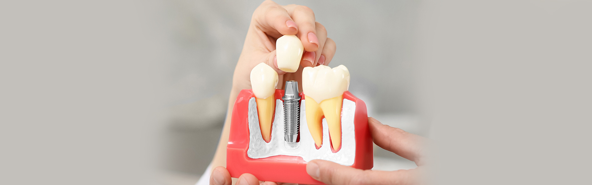 Cosmetic Dental Implants in Jackson, MI