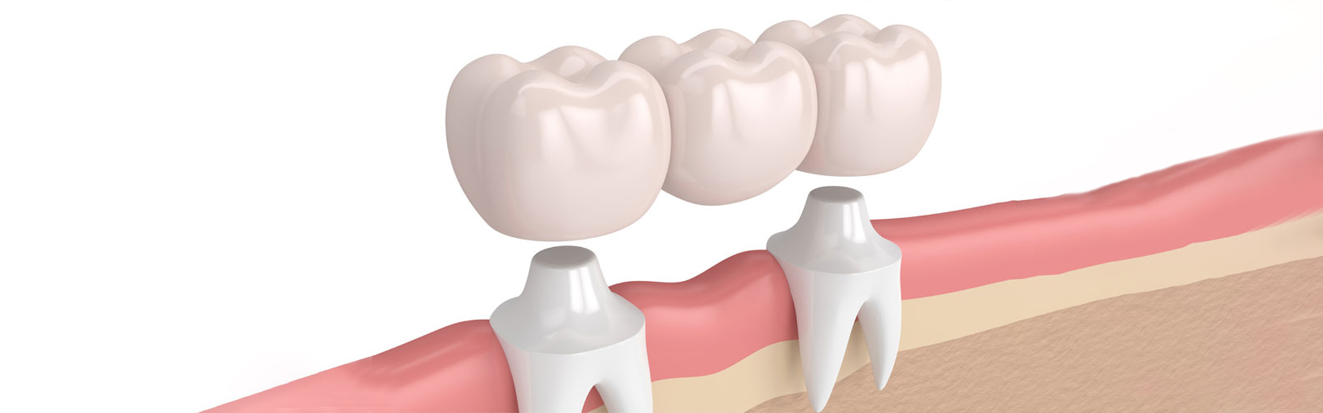 5 Signs You May Require a Dental Crown: When Repairing a Tooth Is Essential