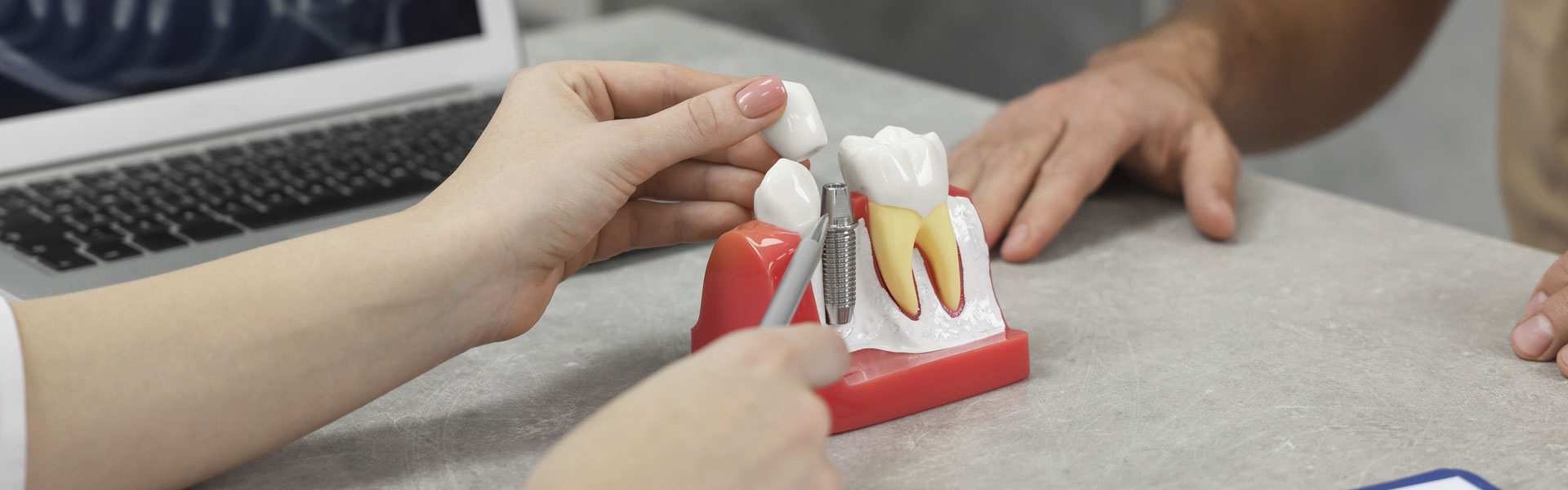 Dental Implants Near You: How AI & CBCT Give You a More Secure Smile