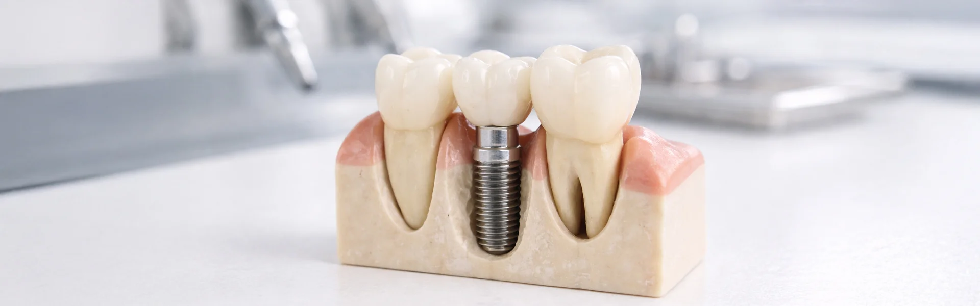 Can-You-Get-Tooth-Implants-in-One-Day-Real-Options-for-Jackson-Residents